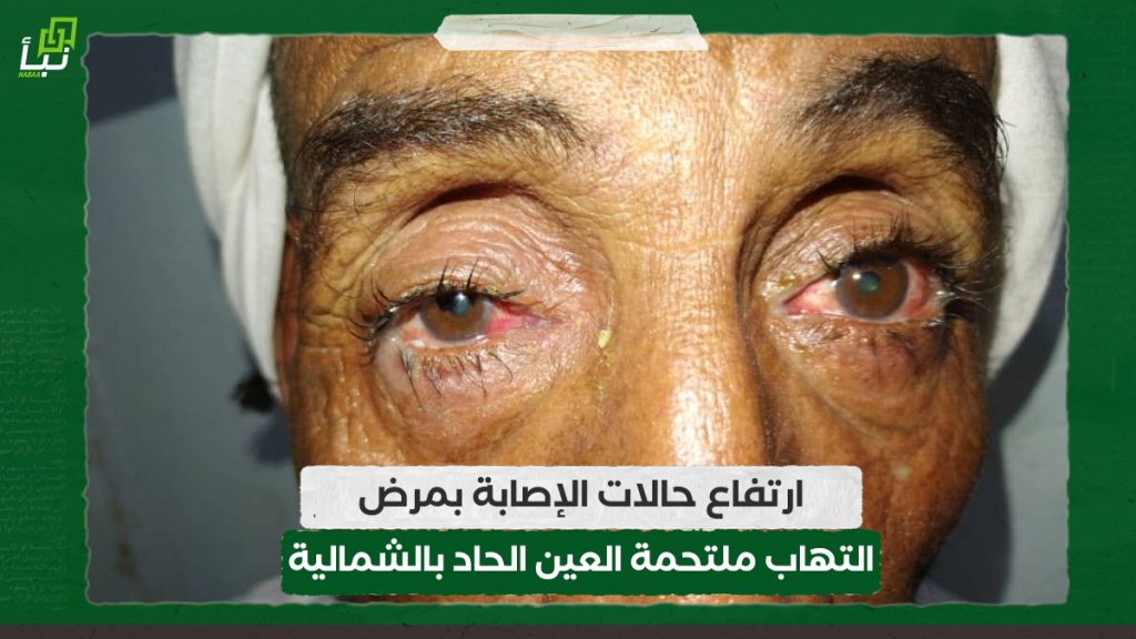 ارتفاع حالات الإصابة بمرض التهاب ملتحمة العين الحاد بالشمالية